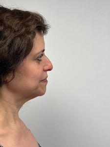 Before Image: Rhinoplasty - right-side